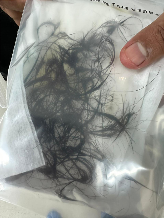Beyond Inflammatory Bowel Disease: Calprotectin as a Marker for Trichobezoar? A Case Report.