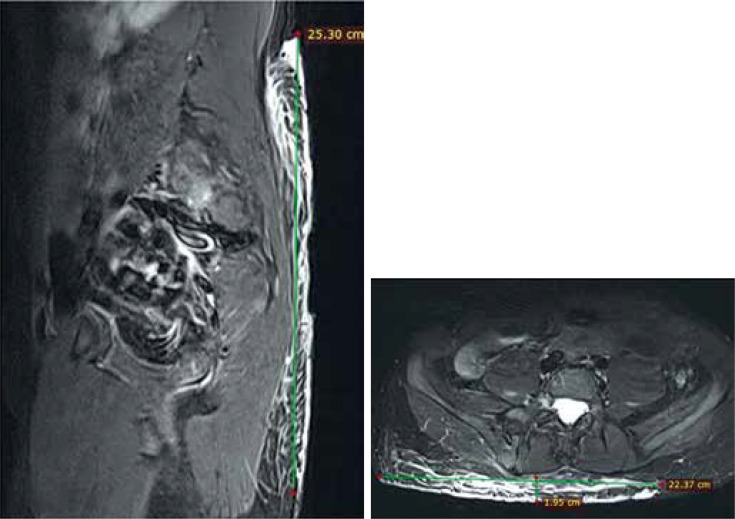 Recommendations of the Polish Medical Radiological Society regarding MRI in patients with plexiform neurofibromas in the course of neurofibromatosis type 1.