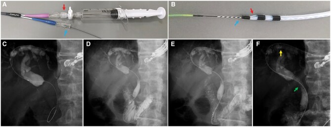 Efficacy of the modified parallel method combined with the double-guide-wire technique for safer endoscopic ultrasound-guided hepaticogastrostomy.