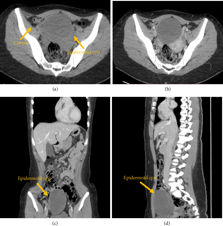 Epidermoid Cyst of the Cecum Treated by Laparoscopic Colectomy: A Case Report With Histopathology and Literature Review.