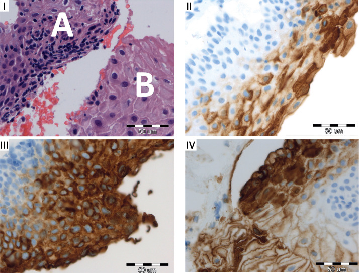 Limited confidence in cervical cancer screening - unusually increased carcinoembryonic antigen expression resulting in the rapid development of cervical intraepithelial neoplasia grade 2.