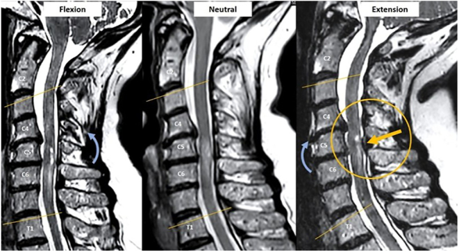 Degenerative cervical myelopathy: timing of surgery.