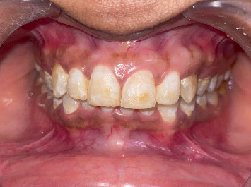 Optimizing Cosmetic Results in Dental Fluorosis: A Case Report of Bleaching and Microabrasion Techniques.