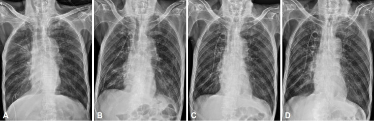 Series of Inadvertent Misplacements of Nasogastric Tube in a Patient.