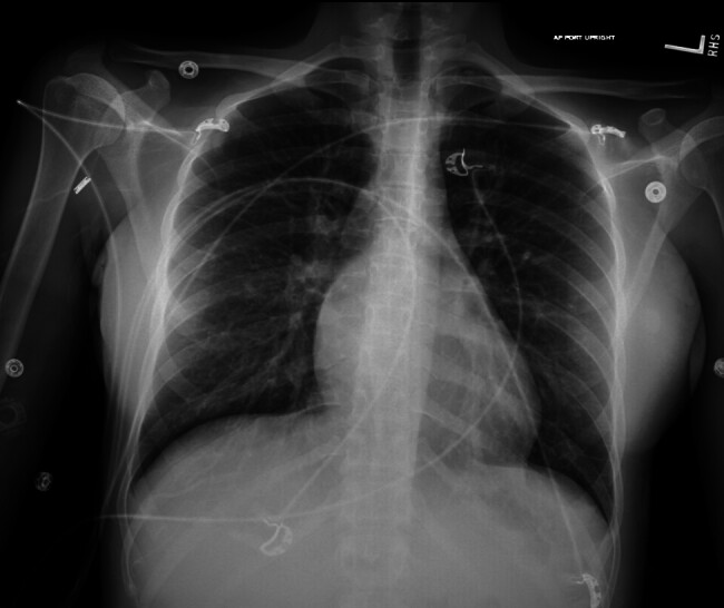 Thyroid Storm Triggered by Partial Hydatidiform Mole: A Rare and Life-Threatening Complication.