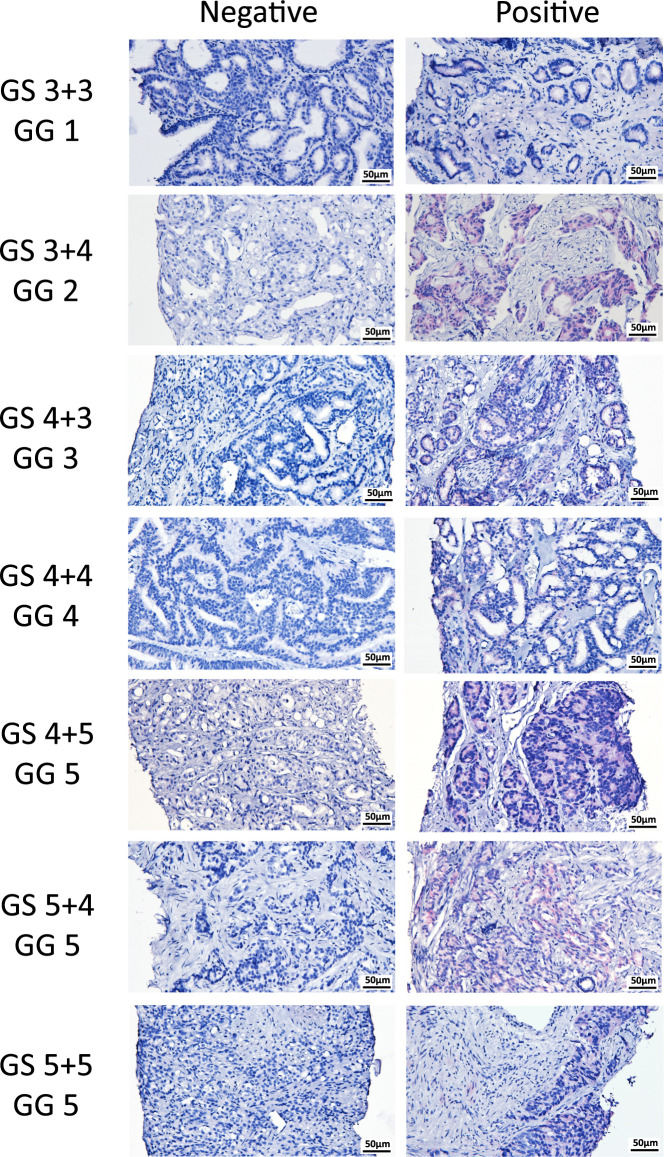 Impact of circ<i>PVT1</i> Expression on Prostate Cancer Malignancy and Tumor Growth.