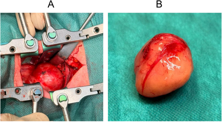 Large Anterior Cervical Spine Schwannoma Causing Dysphagia: Case Report.