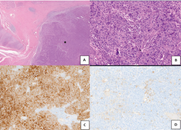 Lympho-epithelial carcinoma of the larynx - the big masquerader of squamous cell carcinoma - a case report.