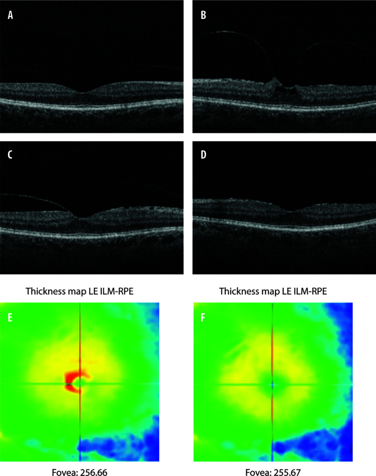 Prevention of epiretinal membrane traction progression with topical indomethacin treatment: a case report and mini literature review.