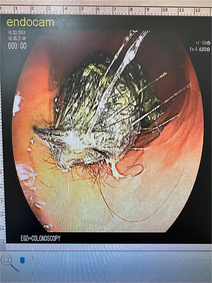 Beyond Inflammatory Bowel Disease: Calprotectin as a Marker for Trichobezoar? A Case Report.