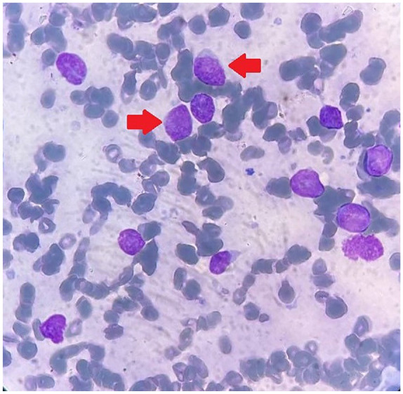 Acute Lymphoblastic Leukemia Presenting With Initial Hyperbilirubinemia and Significantly Elevated Liver Transaminases: A Rare Pediatric Case With Unadjusted Chemotherapy.
