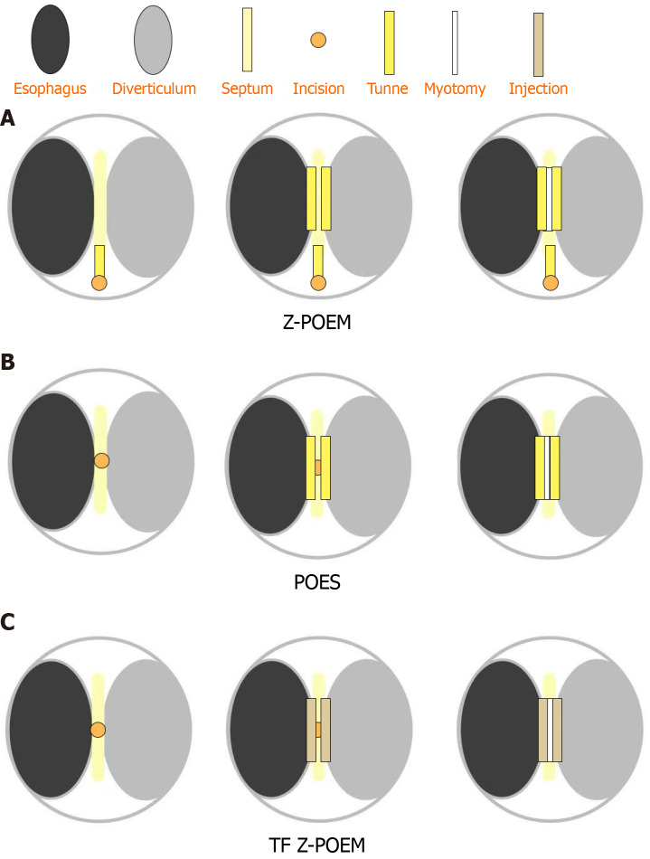 Current status of endoscopic treatment for esophageal diverticulum based on diverticular peroral endoscopic myotomy.