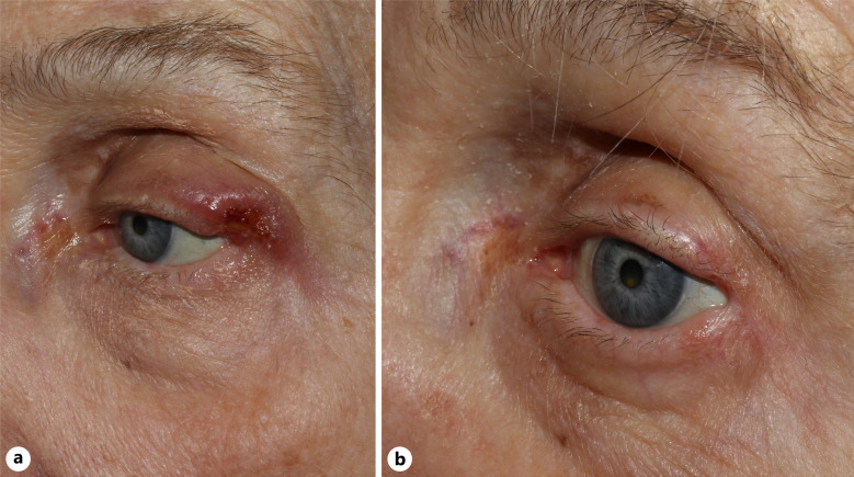 Eyelid Ulcer in an Immunocompromised Patient.