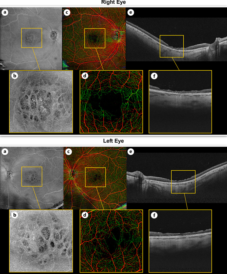 Stair-Case/Honeycomb Maculopathy in Alport Syndrome: A Case Report.