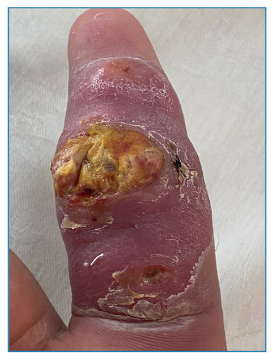Cutaneous nontuberculous mycobacterial infection after intra-articular corticosteroid injection in a patient with psoriatic dactylitis.