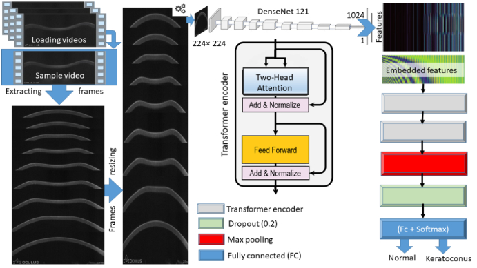 A Hybrid Transformers-based Convolutional Neural Network Model for Keratoconus Detection in Scheimpflug-based Dynamic Corneal Deformation Videos.