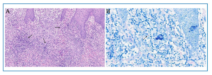 Cutaneous nontuberculous mycobacterial infection after intra-articular corticosteroid injection in a patient with psoriatic dactylitis.