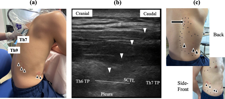 Cephalad intertransverse process block for thoracic herpes zoster: a practical approach to enhance safety and effect.