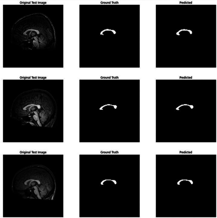 Segmentation with artificial intelligence and automated calculation of the corpus callosum index in multiple sclerosis.