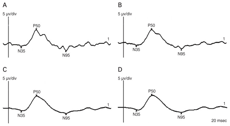 Effect of 50-Hz Filters on Pattern Electroretinogram.