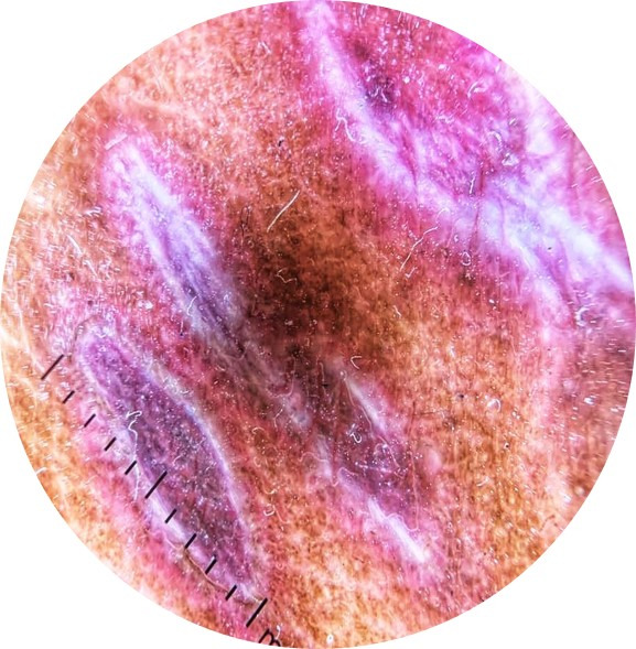 An isoradiotopic response of lichen planus: a case report and review of literature.