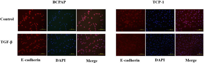 TGF-β induces EMT in thyroid cancer cells by regulating transcription factors.