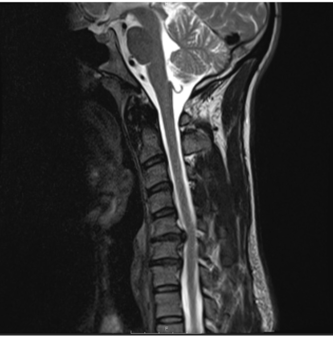 Postoperative Physical Therapy for Cervical Total Disc Replacement: A Case Report.