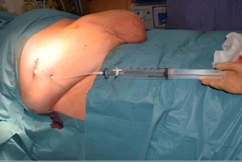 A structured protocol for Preoperative Progressive Pneumoperitoneum (PPP) in Complex Abdominal Wall Reconstruction (CAWR): our York protocol.