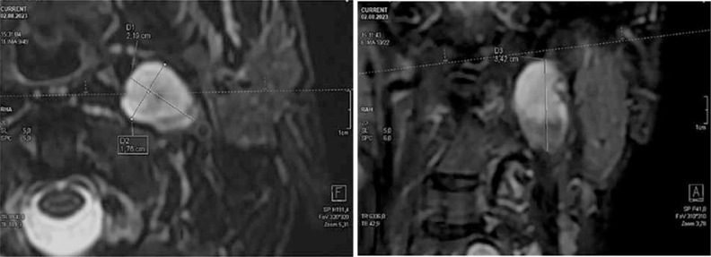 Recommendations of the Polish Medical Radiological Society regarding MRI in patients with plexiform neurofibromas in the course of neurofibromatosis type 1.