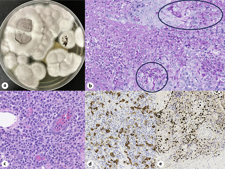 Eyelid Ulcer in an Immunocompromised Patient.