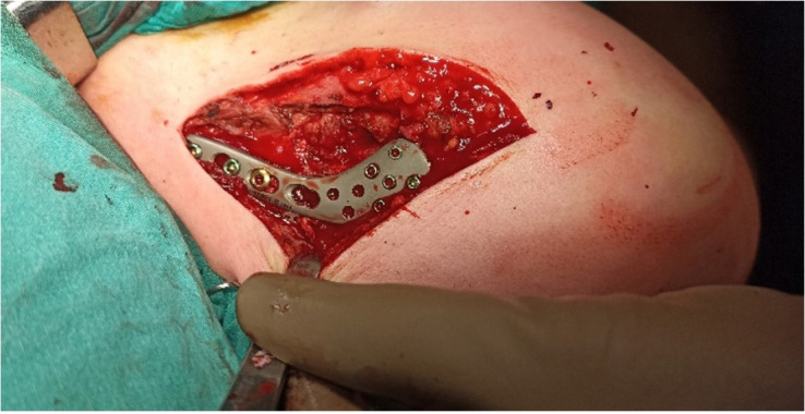 Importance of suture Endobutton augmentation in type 2B clavicle fracture fixation using a locking plate.