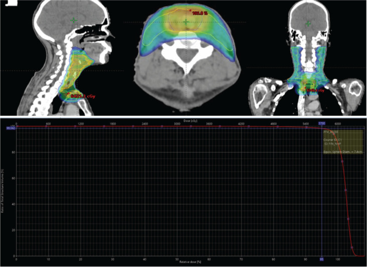 Lympho-epithelial carcinoma of the larynx - the big masquerader of squamous cell carcinoma - a case report.