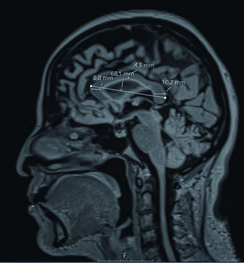 Segmentation with artificial intelligence and automated calculation of the corpus callosum index in multiple sclerosis.