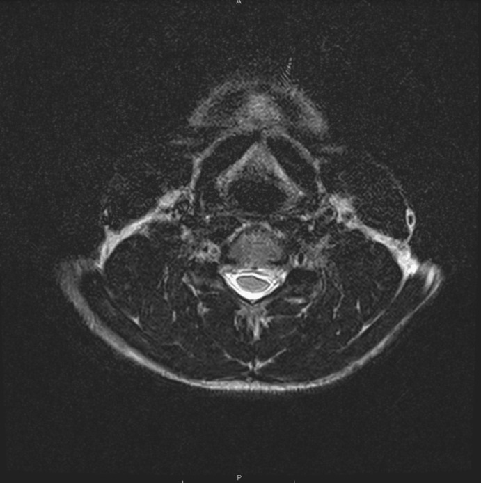 Postoperative Physical Therapy for Cervical Total Disc Replacement: A Case Report.