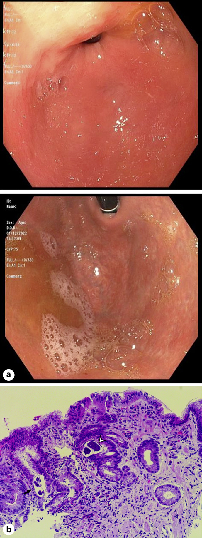 Gastroduodenal Strongyloidiasis Diagnosed during Iron Deficiency Anemia Workup.