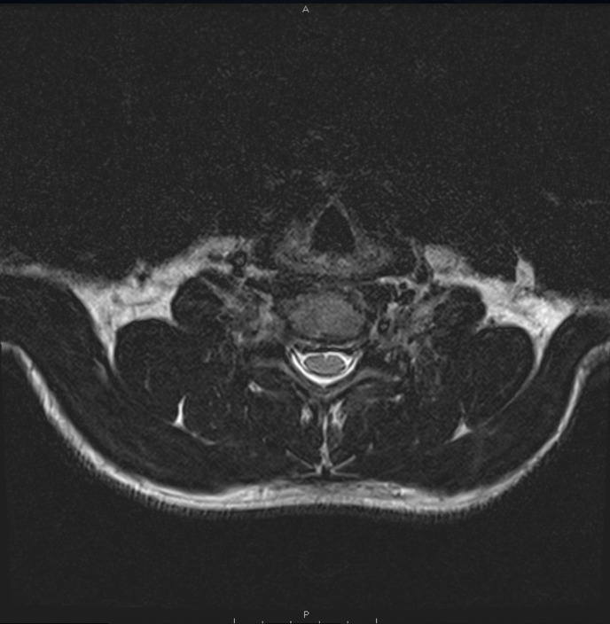 Postoperative Physical Therapy for Cervical Total Disc Replacement: A Case Report.