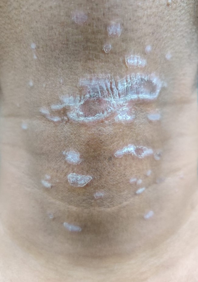 An isoradiotopic response of lichen planus: a case report and review of literature.
