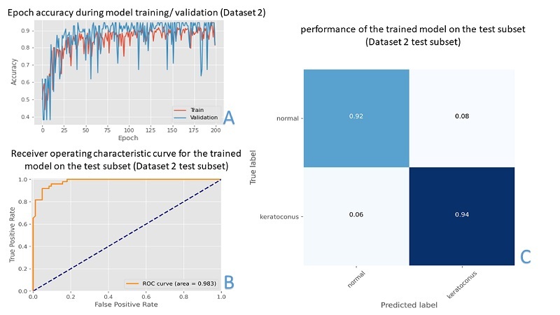 A Hybrid Transformers-based Convolutional Neural Network Model for Keratoconus Detection in Scheimpflug-based Dynamic Corneal Deformation Videos.