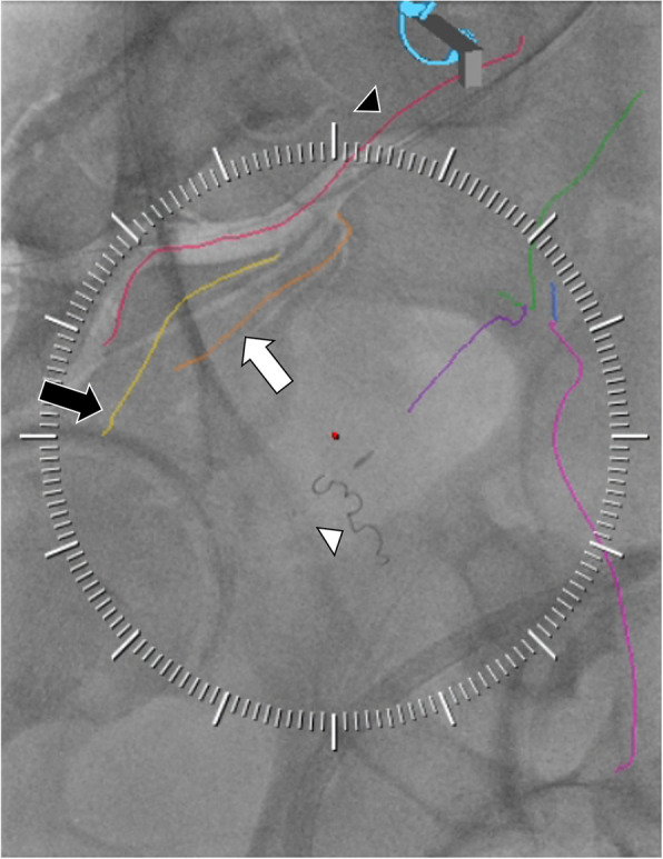 Photon counting detector CTA for prostate artery embolization pre-procedure planning and intra-procedural guidance.
