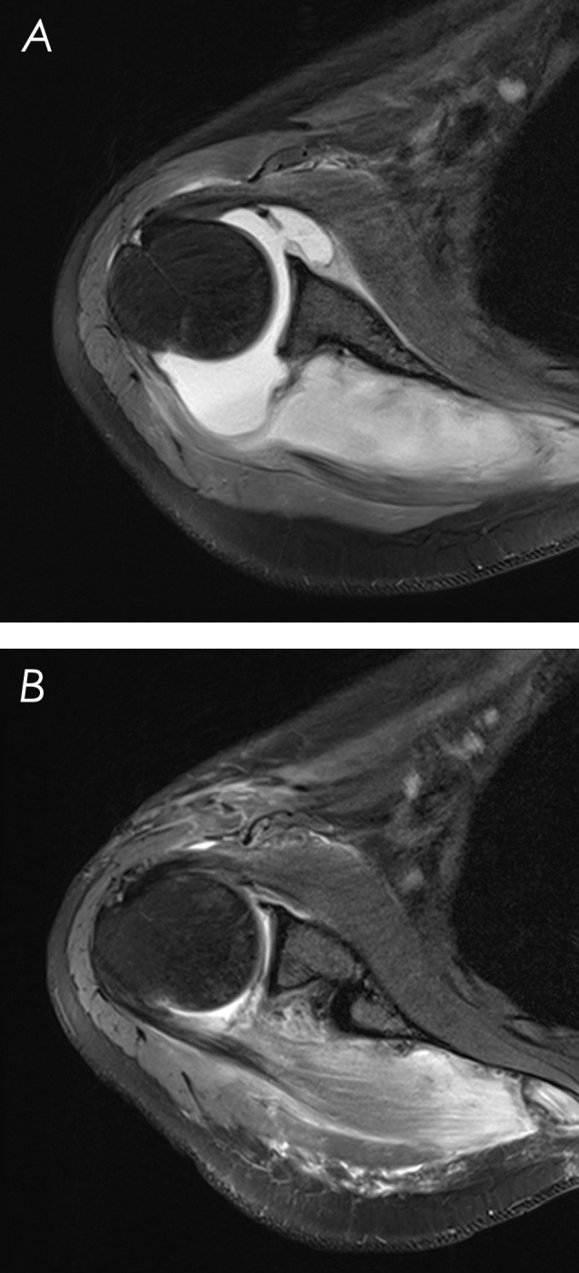 Shoulder paralysis as a presentation of septic arthritis with intramuscular scapular abscess - a case report.