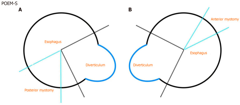 Current status of endoscopic treatment for esophageal diverticulum based on diverticular peroral endoscopic myotomy.