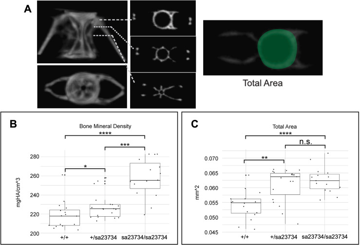 Rare missense variants in <i>FNDC1</i> are associated with severe adolescent idiopathic scoliosis.