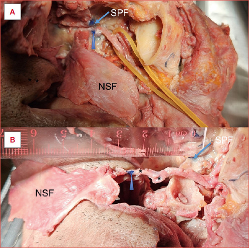 Anatomical basis of the elongated nasoseptal flap.