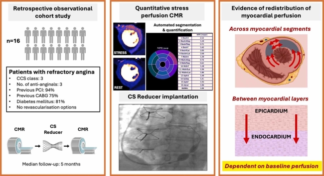 Segmental redistribution of myocardial blood flow after coronary sinus reducer implantation demonstrated by quantitative perfusion cardiovascular magnetic resonance.