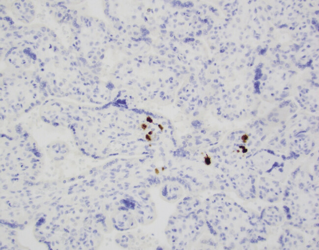 Fetal Cytomegalovirus Associated Intraventricular Hemorrhage: A Rare Prenatal Complication.