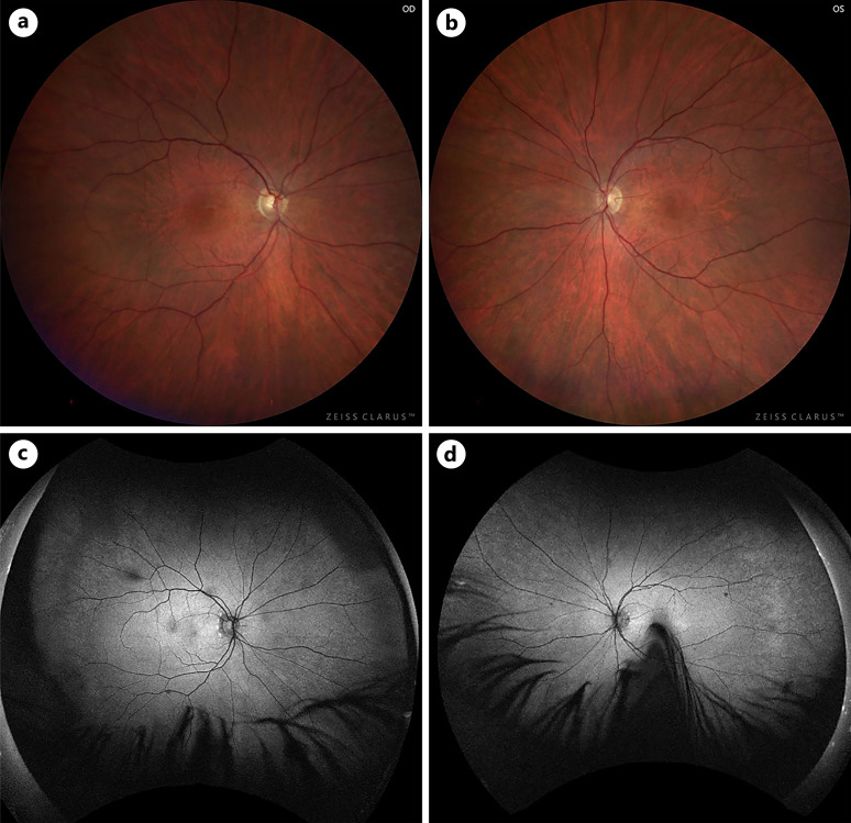 Stair-Case/Honeycomb Maculopathy in Alport Syndrome: A Case Report.