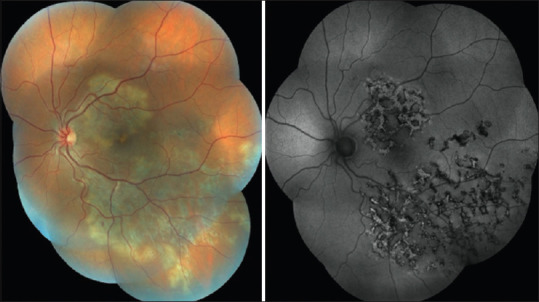 Epidemiological spectrum of infectious uveitis in the Asia-Pacific.