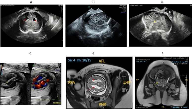 Novel compound heterozygous DOCK6 variants expand the mutational spectrum in prenatal diagnosis of Adams-Oliver syndrome 2.