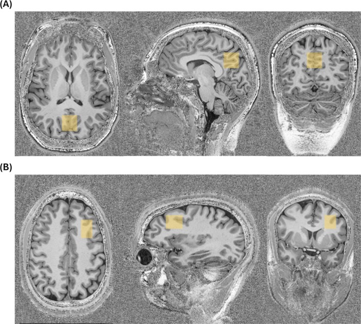 Coil Combination Using OpTIMUS Results in Improved Signal-to-Noise Ratios of In Vivo MR Spectra Acquired at 7 T.
