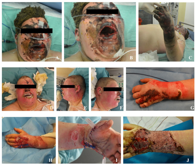Explosion-Related Polytrauma from Illicit Pyrotechnics: Two Case Reports and a Public Health Perspective.